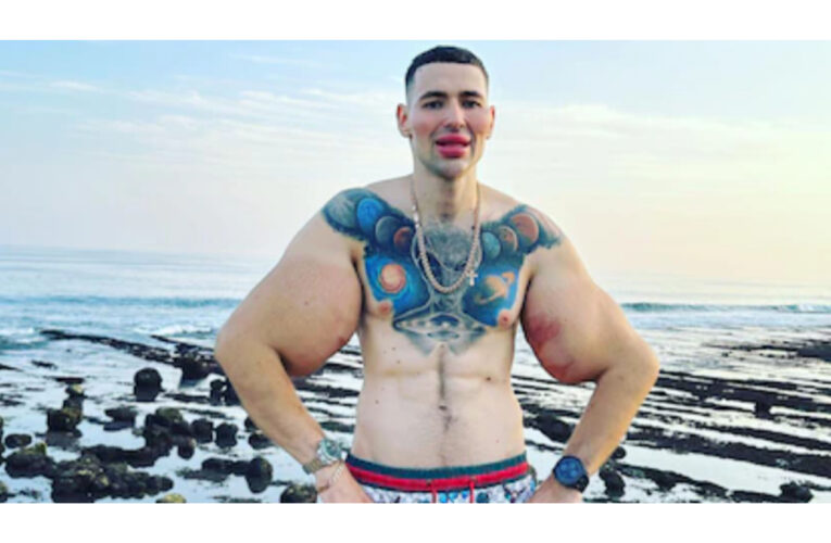 Se inyectó vaselina en los bíceps para hacerlos más grandes y ahora podría perder ambos brazos debido a una infección